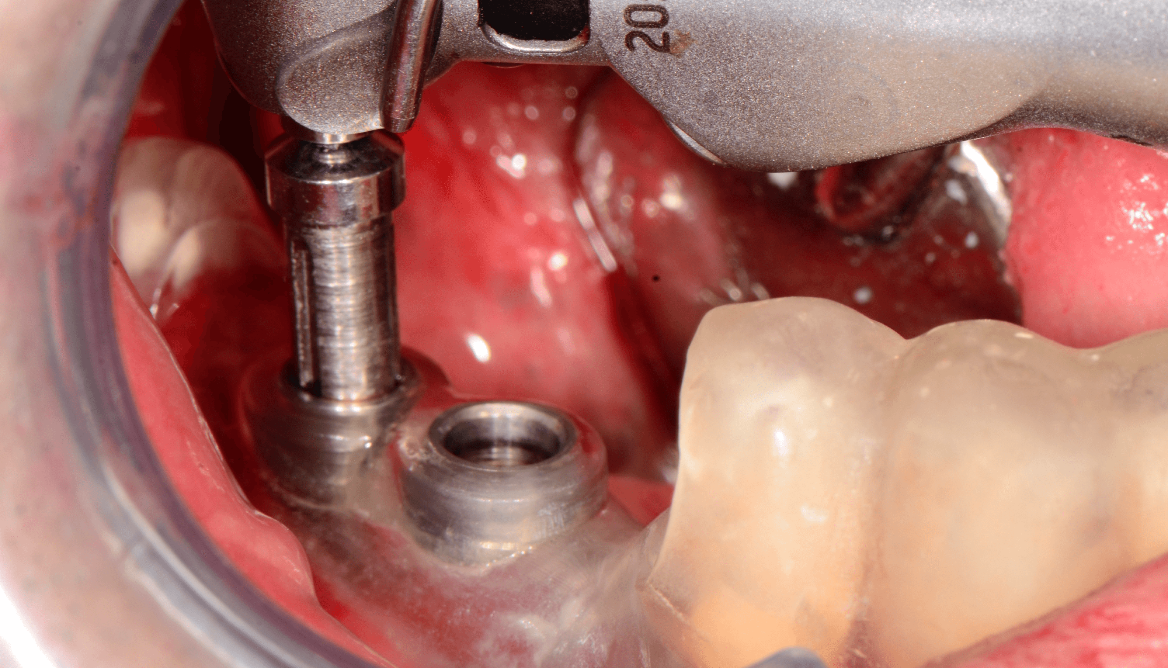 Riabilitazioni Implantari